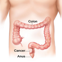 COLORECTAL -1
