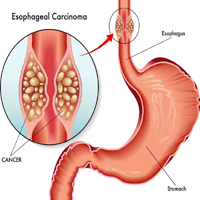 Esophageal-Cancer 1