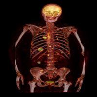 F 18 SODIUM FLUORIDE BONE SCAN 1