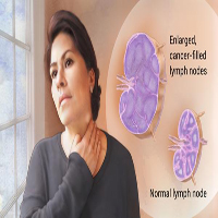 LYMPHOMA-1