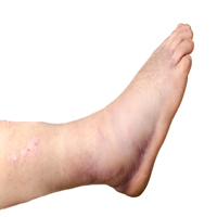 Broken ankle of a person isolated on white background