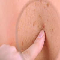 Melanoma Skin Cancer