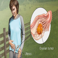 OVARIAN-1