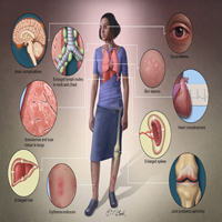 Sarcoidosis-1