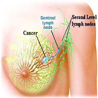 Sentinel Lymph Node