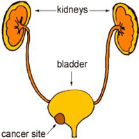 URINARY TRACT CANCER-1