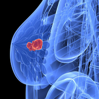 breast_cancer-1