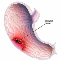 -stomach-cancer 1